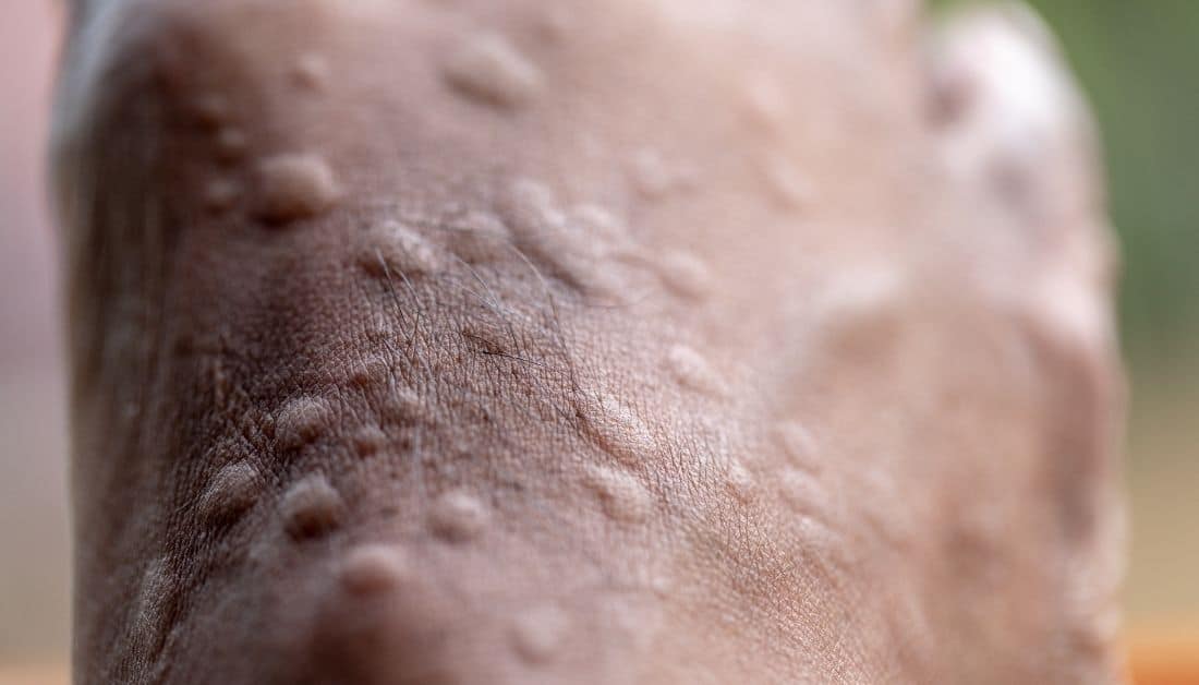 5 House Ants That Bite [One Of Them Makes Your Skin Burn]